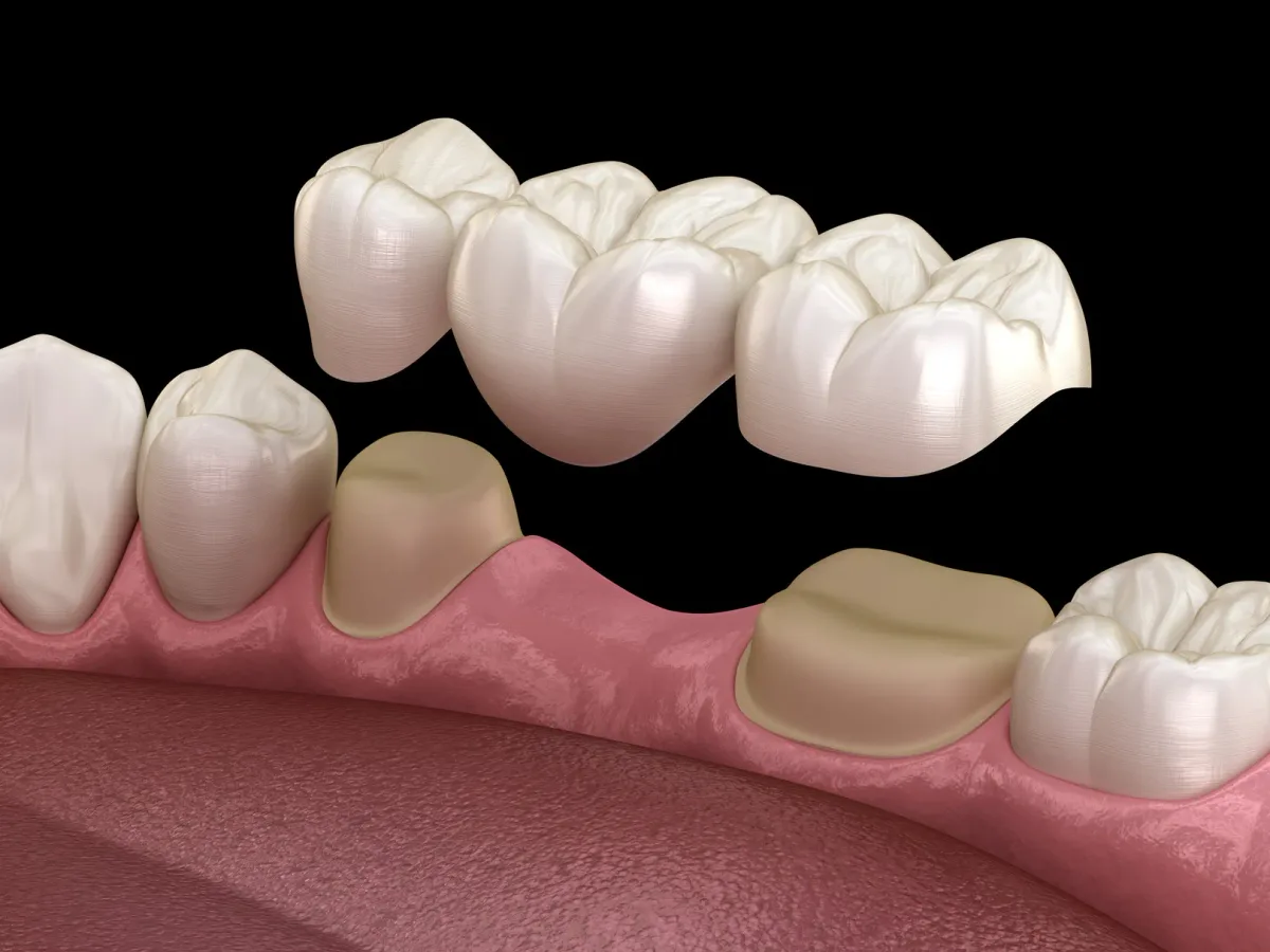 An illustration of a dental bridge spanning a gap between two teeth