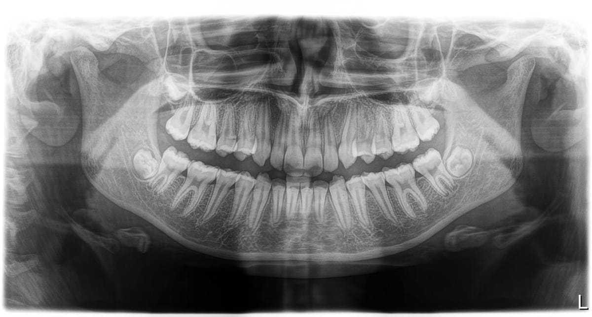 A panoramic dental X-ray used to plan an extraction