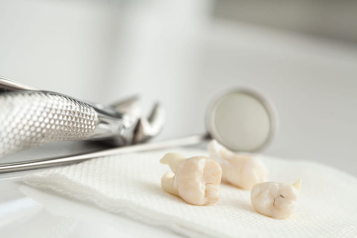 Extracted wisdom teeth beside surgical instruments