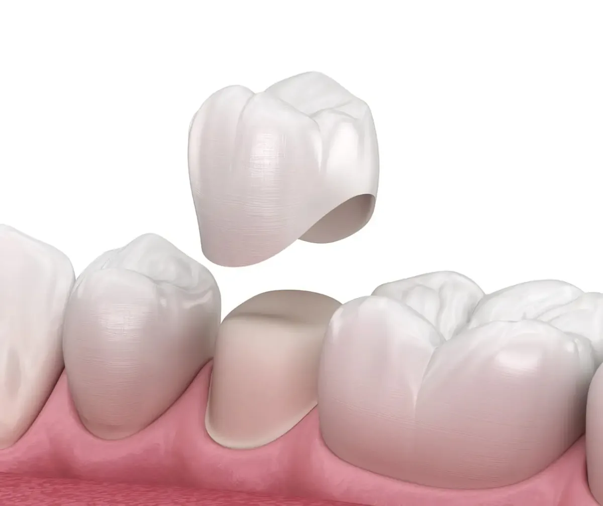 An illustration of a dental crown being seated over a prepared tooth