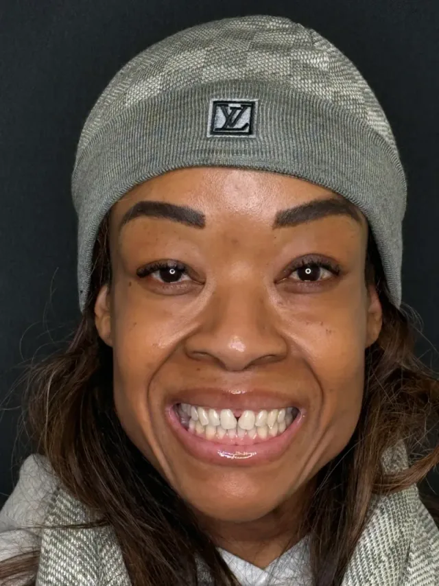 Alisha before Top Veneers & Lower Whitening at White32 Dental