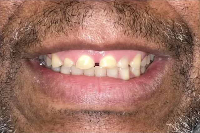 Gene after treatment at White32 Dental, Gum Lift & 6 Porcelain Crowns