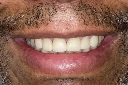 Gene before treatment at White32 Dental, Gum Lift & 6 Porcelain Crowns