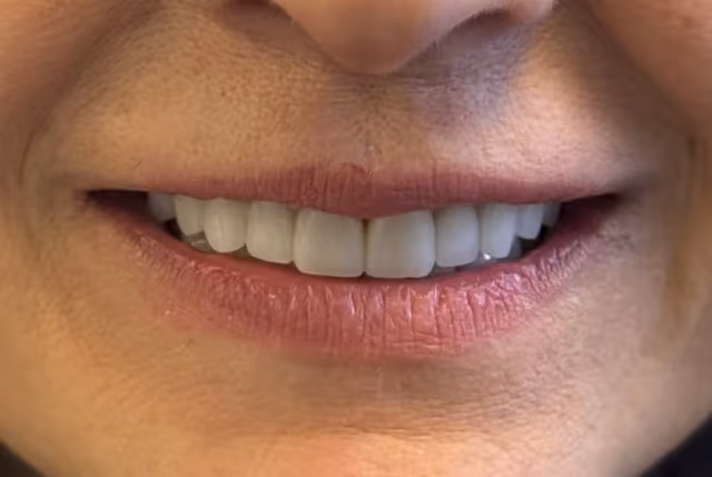 Harper* after treatment at White32 Dental, Full Set Cosmetic Veneers