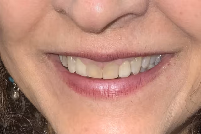 Harper* before treatment at White32 Dental, Full Set Cosmetic Veneers