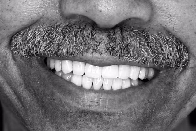 Jack* after treatment at White32 Dental, Full Set of Porcelain Veneers