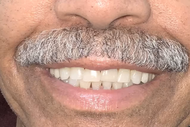 Jack* before treatment at White32 Dental, Full Set of Porcelain Veneers