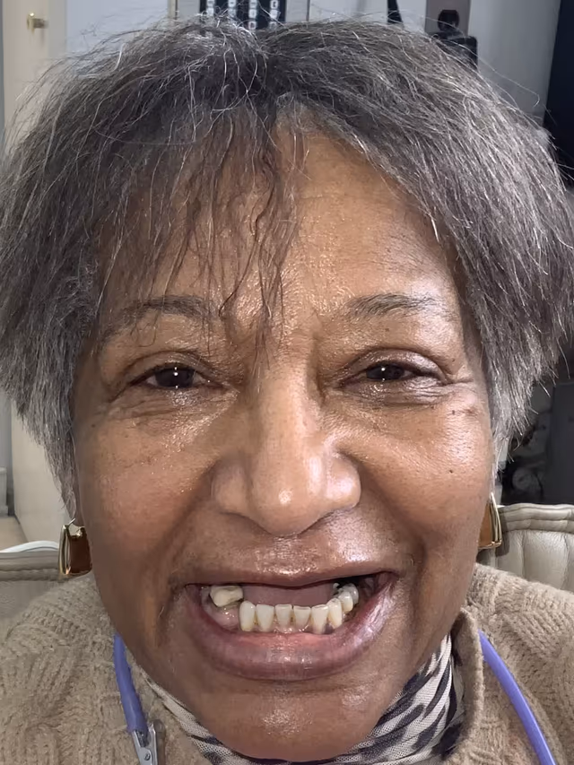 Jan before treatment at White32 Dental, Implant-Retained Upper Denture