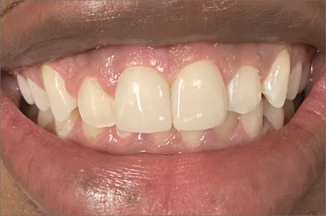 Jessica after treatment at White32 Dental, Custom Porcelain Crowns