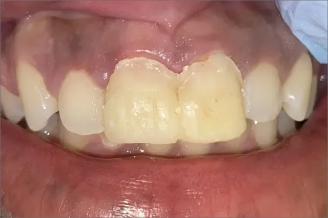 Jessica before treatment at White32 Dental, Custom Porcelain Crowns