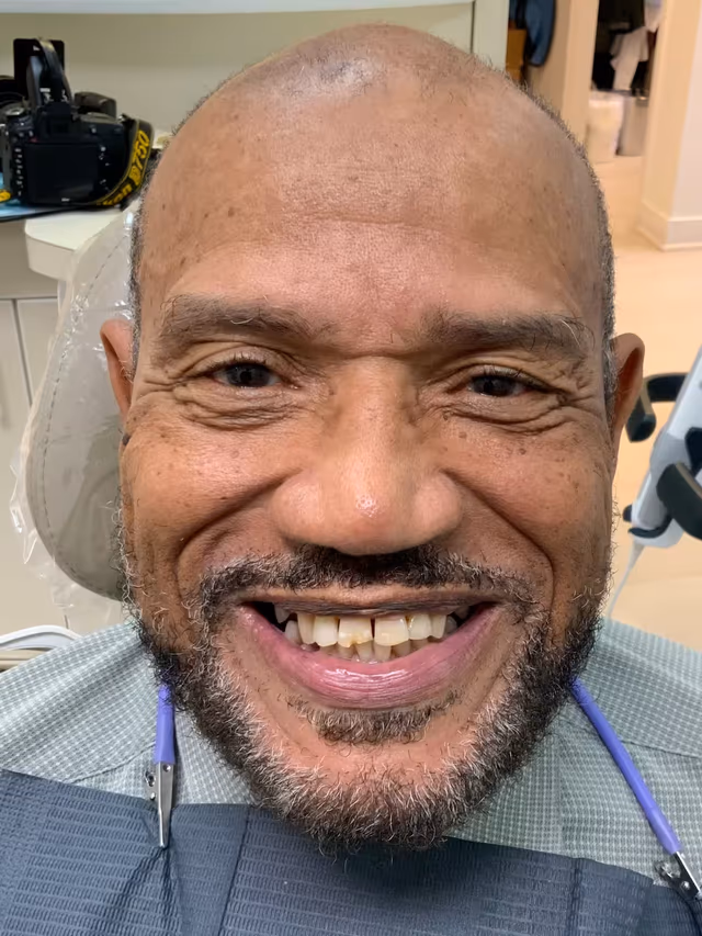 John before treatment at White32 Dental, Implants, Crowns & Veneers