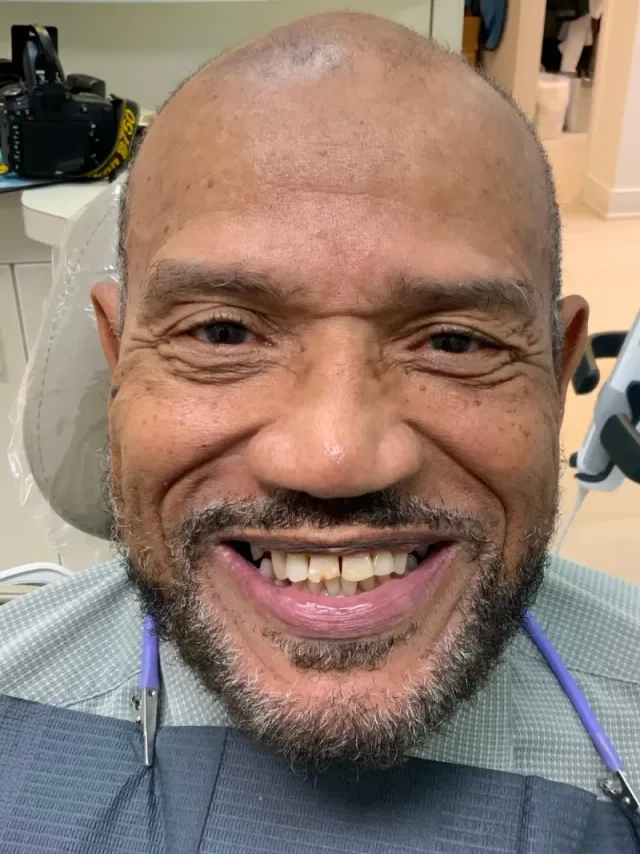 John before Implants, Crowns & Veneers at White32 Dental