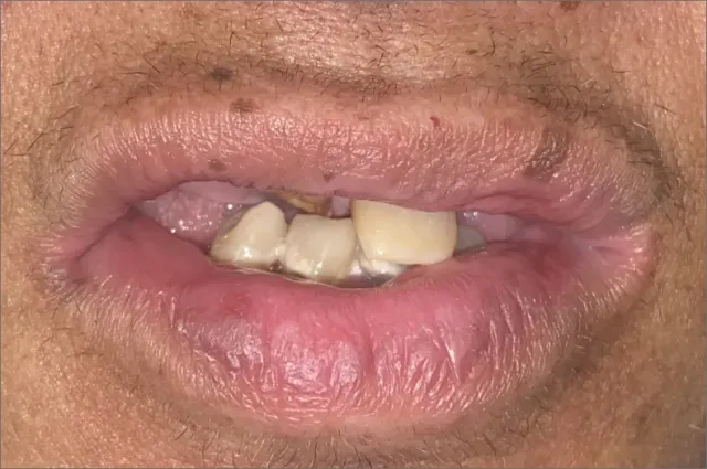 June after treatment at White32 Dental, Comprehensive Smile Makeover
