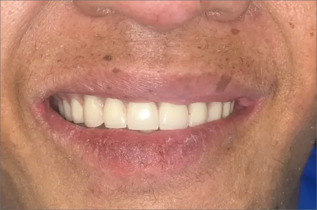 June before treatment at White32 Dental, Comprehensive Smile Makeover