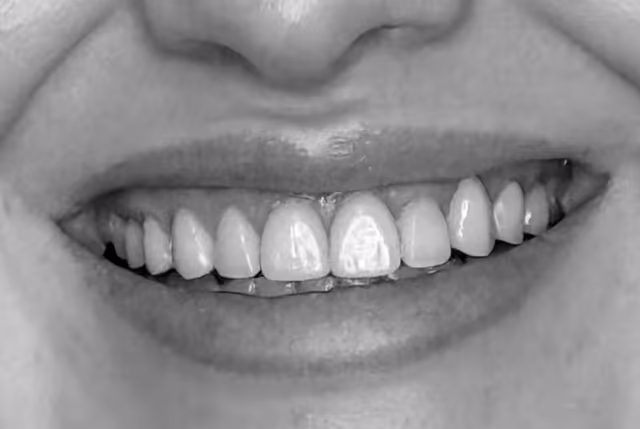Libby* after treatment at White32 Dental, Invisalign®, Veneers & Implant Crown