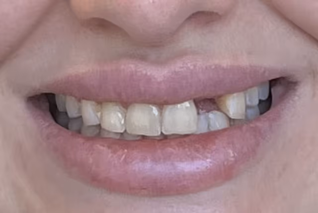 Libby* before treatment at White32 Dental, Invisalign®, Veneers & Implant Crown