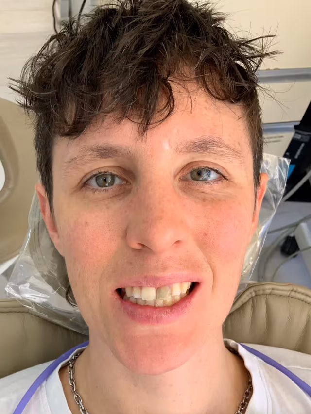 Louise* before treatment at White32 Dental, Veneers, Crowns & Whitening