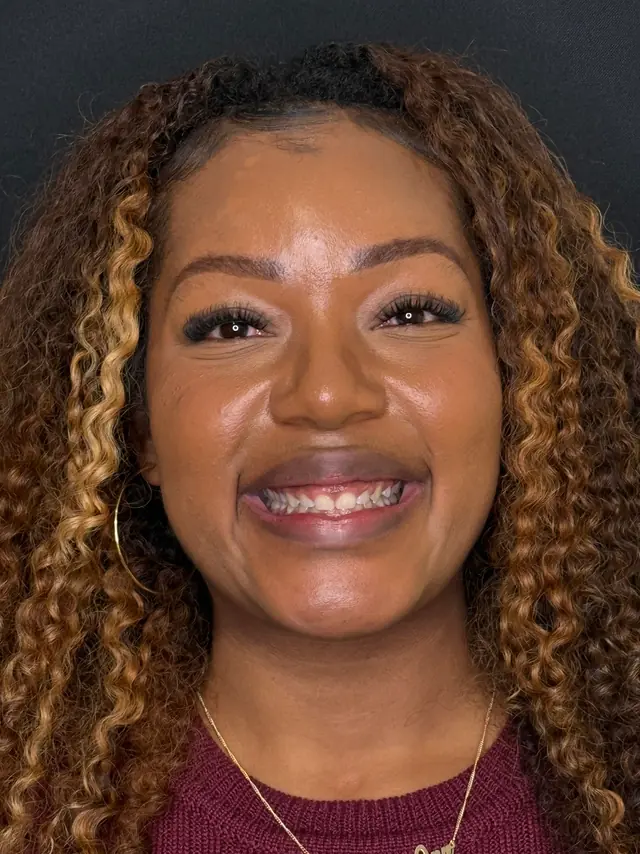 Paula-Ann before treatment at White32 Dental, Permanent Crown Lengthening