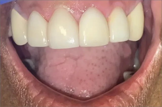 Rebecca after treatment at White32 Dental, Precision Veneer Match