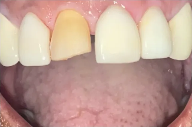 Rebecca before treatment at White32 Dental, Precision Veneer Match