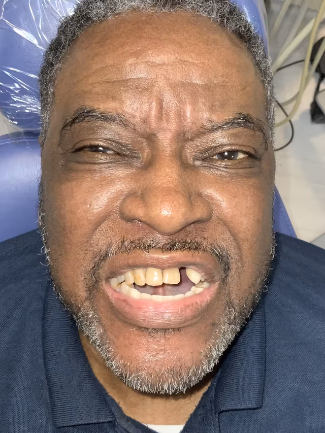 Ron before treatment at White32 Dental, Implants, Crowns & Bridges