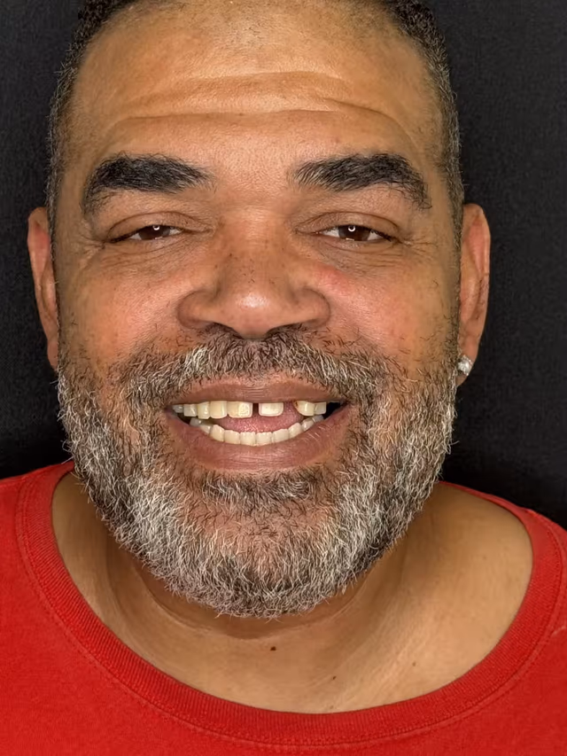 Terry before treatment at White32 Dental, All-on-4 Fixed Dentures