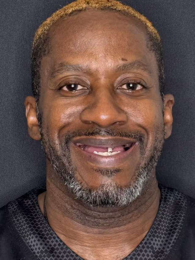 Tristan before treatment at White32 Dental, Upper & Lower Dentures
