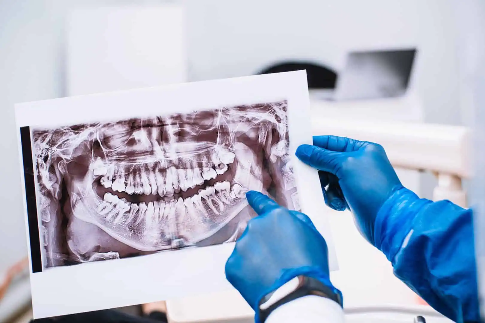 A calm, instrument-free image representing wisdom teeth removal care at White32 Dental